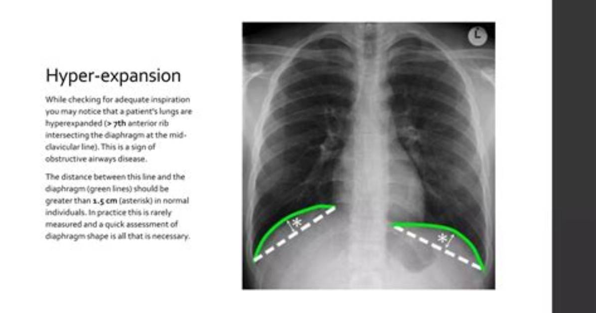 How Tall Is Clavicular? Fact-Checking Rumors, Claims, and Surgeries
