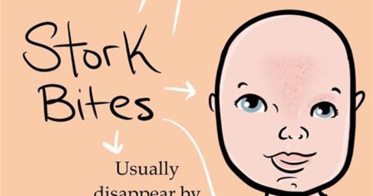 Is a Stork Bite a Sign of Mthfr Mutation? the Viral Myth Debunked by Pediatricians