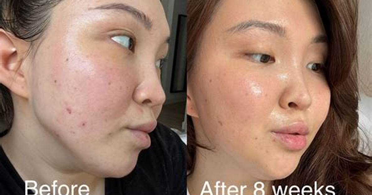 Medicube Before and After Fact-Check: Are Celebrity Endorsements Concealing Flaws?
