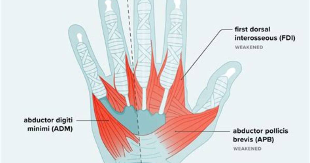 New Clinical Warnings on Hand Weakness: When Slipping Grip Signals Serious Nerve Trouble