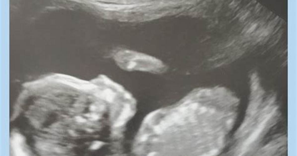 When Can You Find out Your Baby's Gender? How Accidental Clinic Leaks Ruin the Big Reveal