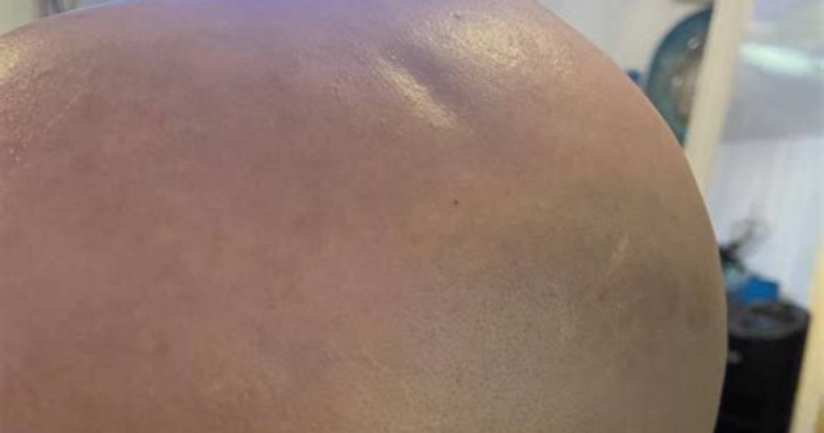 Why Are There Dents in My Head? Complete Medical Guide and Common Causes
