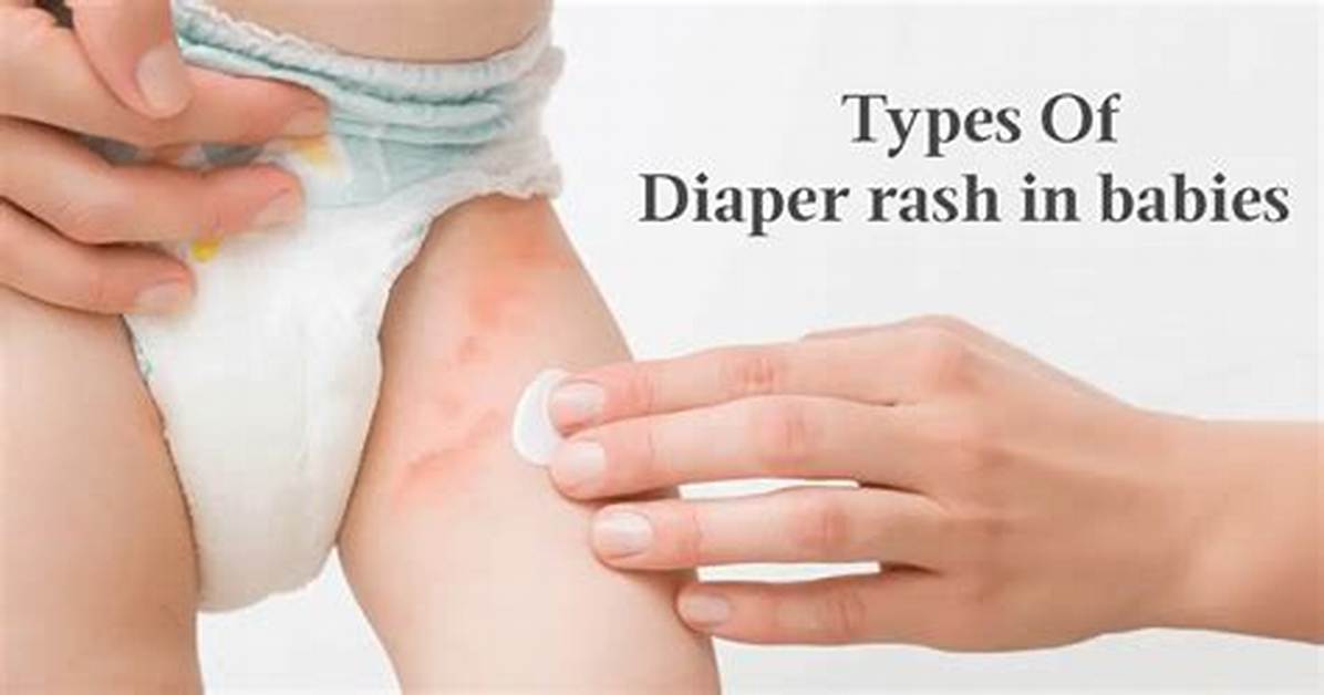 Why Kiwi Triggers Sudden Baby Diaper Rash: the Solid Starts Acidic Fruit Alert